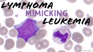 Circulating Diffuse Large Bcell Lymphoma Cell Mimicking Acute Myeloid Leukemia AML Blast Hematology [upl. by Humpage278]