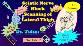 Ultrasound guided parasacral approach of the sciatic nerve [upl. by Luz573]