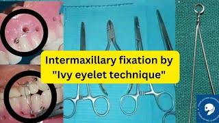 INTERMAXILLARY FIXATION IMF [upl. by Sixele724]