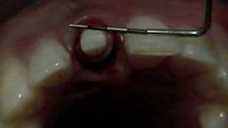 CeraRoot Zirconia Dental Implant Surgery central Incisor [upl. by Clarice]