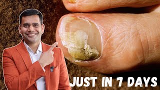 Just in 7 Days Cure Toenail Fungus At Home  Best Remedy For Toenail Fungus  Dr Vivek Joshi [upl. by Monjo]