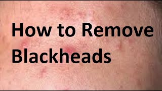 How to Remove BlackheadsWhat Causes Blackheads [upl. by Mathia]