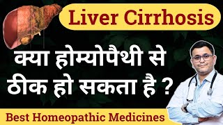 Liver cirrhosis homeopathy treatment Homeopathic medicine for Liver Cirrhosis [upl. by Seraphim]