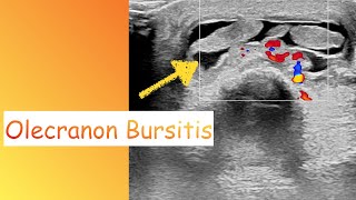 Olecranon Bursitis Ultrasound [upl. by Rona444]