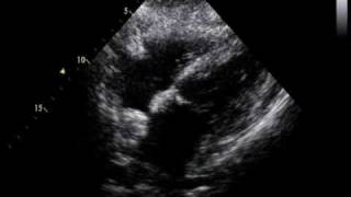 lipomatous hypertrophy of the interatrial septumcase twosubcostal view [upl. by Hpsoj453]