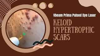 Vbeam Prima Pulsed Dye Laser  Keloid Hypertrophic Scars  West Hollywood CA  Dr Jason Emer [upl. by Yci]