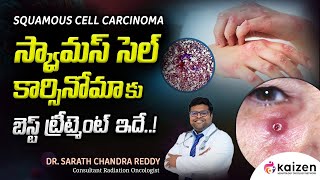 BEST treatment for squamous cell carcinoma  DrSarath Chandra Reddy  Kaizen Hematology Network [upl. by Heathcote]