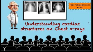 Interpreting heart on chest xrays [upl. by Marcoux]