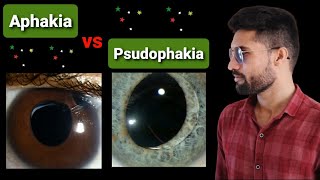 Aphakia  Psudophakia lecture opthalmology [upl. by Meelas]