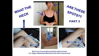 WHAT ARE THESE SPOTS  IMMUNOTHERAPY NIVOLUMAB RASH PART 3 [upl. by Icyac]