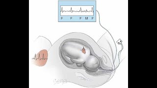 finalyearprojects 2021  Smart Cardiotocography Fetal Monitoring System based on Phonocardiogram [upl. by Berneta]