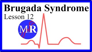 Brugada Syndrome [upl. by Lincoln]