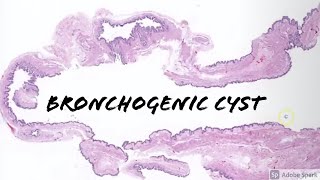 Bronchogenic Cyst 5Minute Pathology Pearls [upl. by Chuck323]