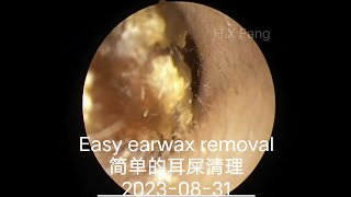 super easy earwax removal简单的耳屎清理20230831 [upl. by Depoliti]