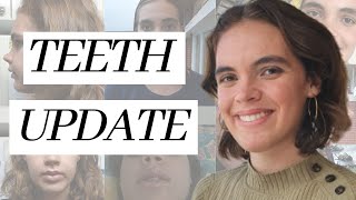 3 Years After Braces amp Jaw Surgery [upl. by Keeton650]