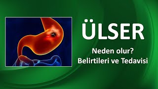 ÜLSER NEDİR NASIL TEDAVİ EDİLİR [upl. by Eimorej325]