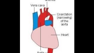 Coarctation of the Aorta [upl. by Dita935]