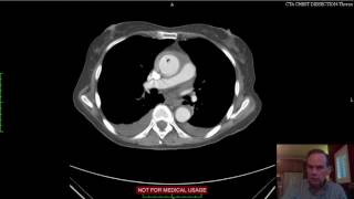 Aortic Mural Hematoma CT [upl. by Otreblon]