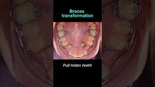 Braces transformation Hiden teeth not problem braces orthodontist dentist dental [upl. by Haroved651]