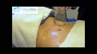 VelaShape Treatment for Cellulite at ClearSkin [upl. by Crowell]