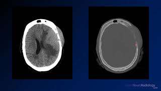 Neuroradiology board review 3 case 4 [upl. by Tacye]