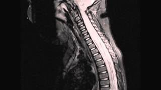 Transverse Myelitis [upl. by Darton]