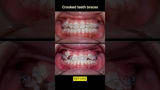 Crooked teeth amp underbite braces [upl. by Catie594]