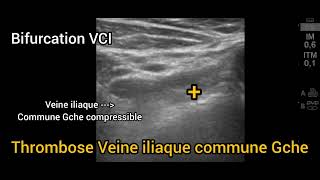 Thrombose veineuse profonde proximale étendue Iliaque Fémorale Membre inférieur Échographie [upl. by Onirefes513]