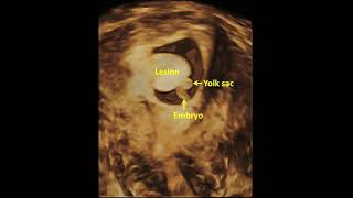 Early pregnancy complication  Chorionic bump  Ultrasound findings [upl. by Ecyak]