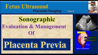 Fetus Ultrasound Placenta Previa [upl. by Ymmac806]