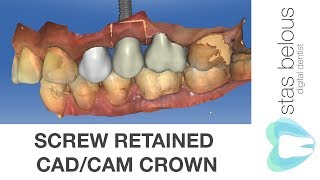 Screw retained Ankylos implant Cadcam Cerec omnicam Crown Emax Hole block A14S Stas Belous [upl. by Nyrol451]