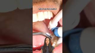 dental sealants procedure shorts [upl. by Thetisa586]