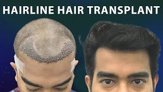 Natural Looking Hairline Transplant at Hairfree Hairgrow Clinic Kolkata using Sapphire FUE Method [upl. by Ellerihs]