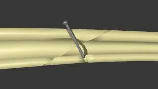 Fracture Fixation Lag Screw [upl. by Laryssa]