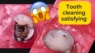 Tooth decay removal with restauration 🥵 see what the dentist do to your teeth original sound 🥵🥵 [upl. by Lennor]