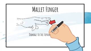 Mallet Finger Treatment EVERYTHING YOU NEED TO KNOW TO SELF TREAT [upl. by Nav976]