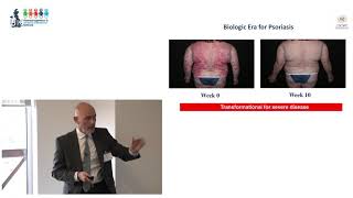 Stratified Medicine in psoriasis research [upl. by Nary]