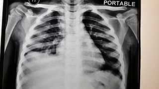 Right sided hepatomegaly or pleural effusion [upl. by Lorenz]