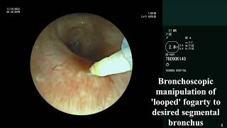 Bronchoscopic Endobronchial Blocker placement  Look amp Park Technique [upl. by Lenox]