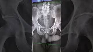 Fracture of pubic symphysis xrays fracture [upl. by Keithley254]