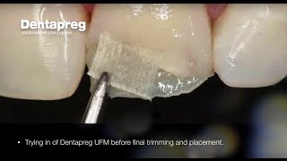 Restoration of Chipped Incisal Edge by Dr Dennis Hartlieb [upl. by Cynthie]