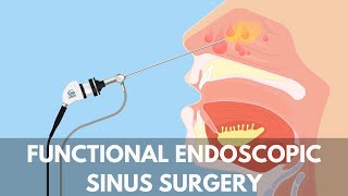 What is a Functional Endoscopic Sinus Surgery [upl. by Sup]