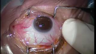 Lucentis Intravitreal Injection Technique for maculopathy [upl. by Abdella699]