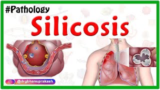 Silicosis Miners phthisis Grinders asthma  Etiology  Pathophysiology  Diagnosis Treatment [upl. by Islek]