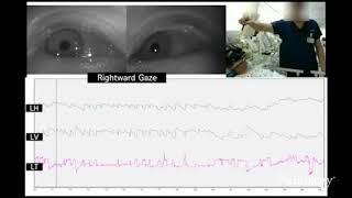 Upbeat and horizontal gazeevoked nystagmus in bilateral medial medullary infarction [upl. by Belle]