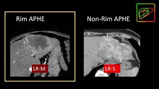 5 LIRADS Malignant lesions that are not definitely HCC LRM  Part 1 By Dr Kathryn Fowler [upl. by Eillor582]