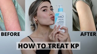 HOW TO GET RID OF KP ON ARMS  KERATOSIS PILARIS [upl. by Christoper]