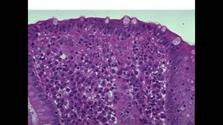 Microscopic Colitis Diagnosis and Treatment [upl. by Ranip748]