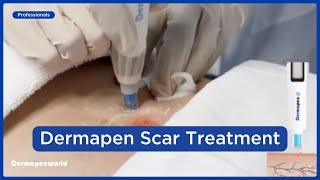 Dermapen 4™ Microneedling  Advanced Scar Treatment Techniques [upl. by Amend]