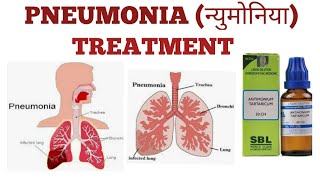 PNEUMONIAन्युमोनिया HOMOEOPATHIC TREATMENT [upl. by Ifar]